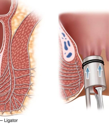 İç Hemoroid