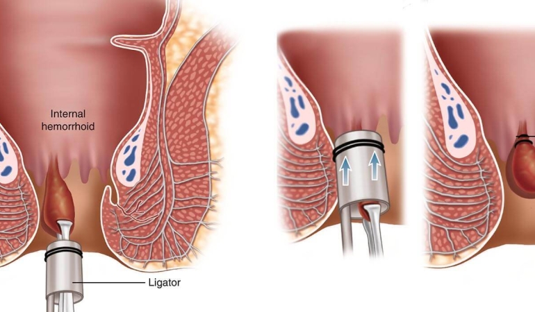 İç Hemoroid